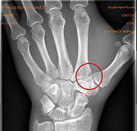 Handwurzelknochen gebrochen
Dateiname: Hand-Oben.jpg