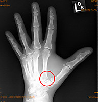 Handwurzelknochen gebrochen
Dateiname: Hand-Seitlich.jpg