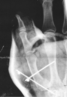 Daumenfraktur
Dateiname: broken_bones1.PNG