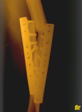 xray_hannes_before_side_h450