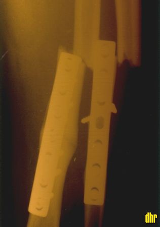 xray_hannes_before_top_h450
